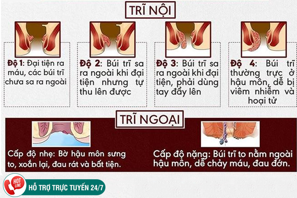 Bệnh viện bệnh trĩ tốt, uy tín, có bác sĩ giỏi ở Đắk Lắk