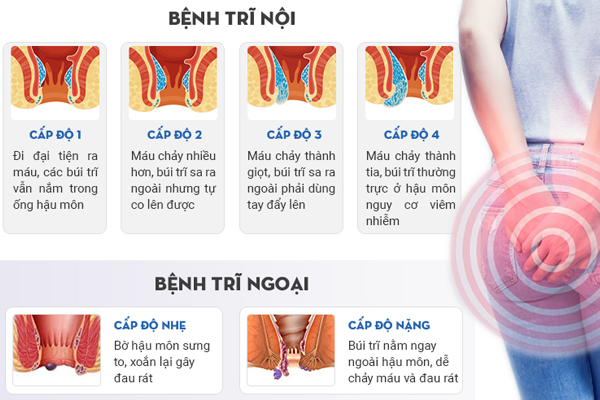 Cách chữa bệnh trĩ nội, ngoại, hỗn hợp - Phương pháp mới, hiệu quả nhanh
