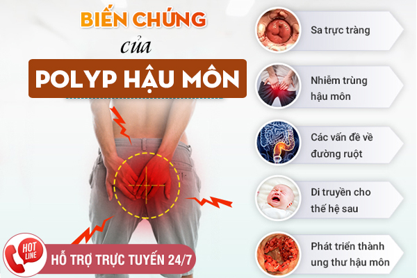 Chi phí chữa Polyp hậu môn bao nhiêu tiền? Cập nhật bảng giá mới
