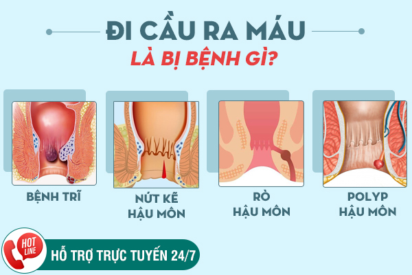 Đi cầu ra máu cuối bãi là bị gì? Cách chữa trị hiệu quả