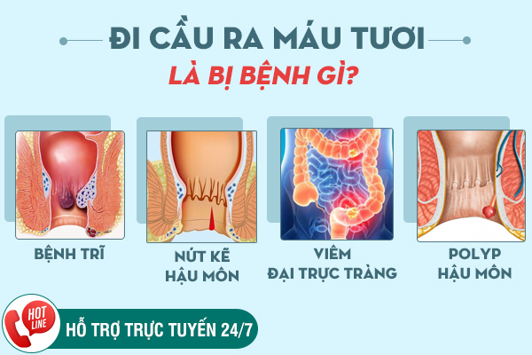 Đi cầu ra máu tươi nhỏ giọt - Dấu hiệu chớ xem nhẹ