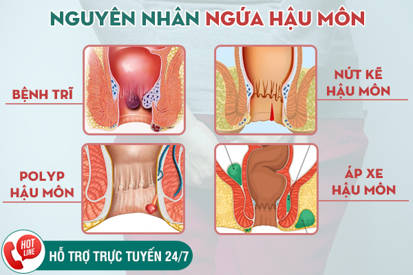 Ngứa hậu môn là bị gì? Cách làm dịu cơn ngứa hiệu quả, nhanh chóng