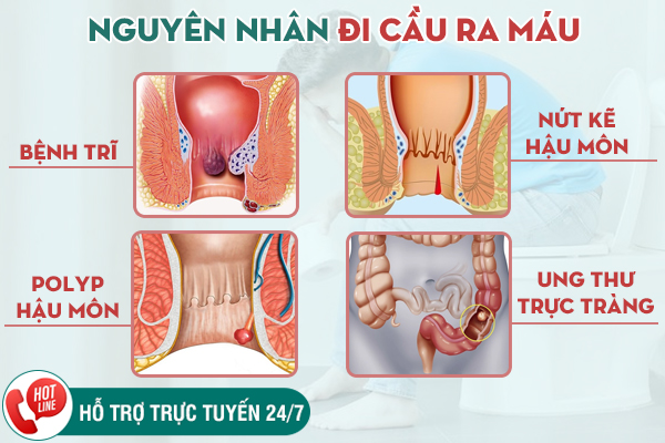 Triệu chứng đi cầu ra máu cảnh báo bệnh gì?